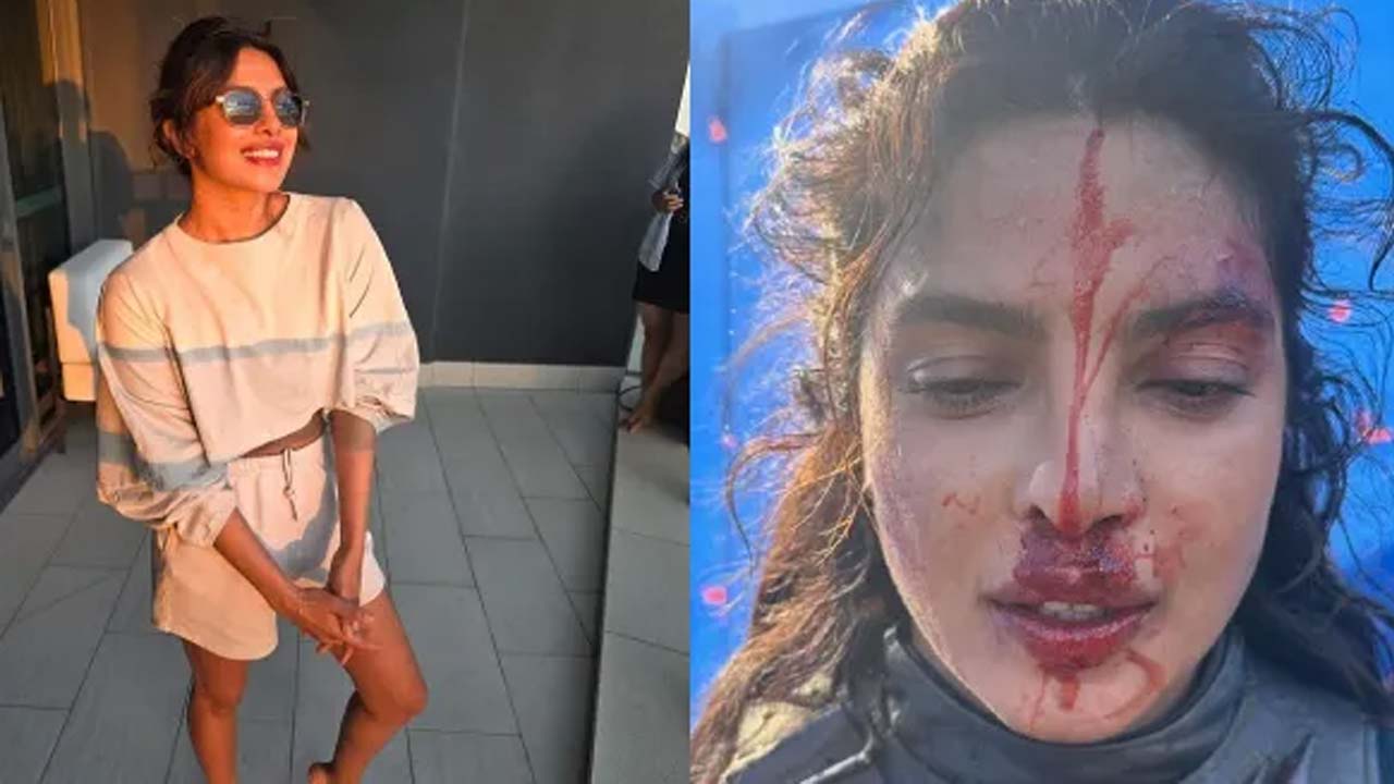 Priyanka Chopra's Injured Face And Hands Photos Cause Concern, Here's The Truth Priyanka Chopra's Injured Face And Hands Photos Cause Concern, Here's The Truth