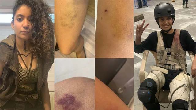 Anna Ben Injured During 'Kalki' Shoot, Shares Photos Anna Ben Injured During 'Kalki' Shoot, Shares Photos