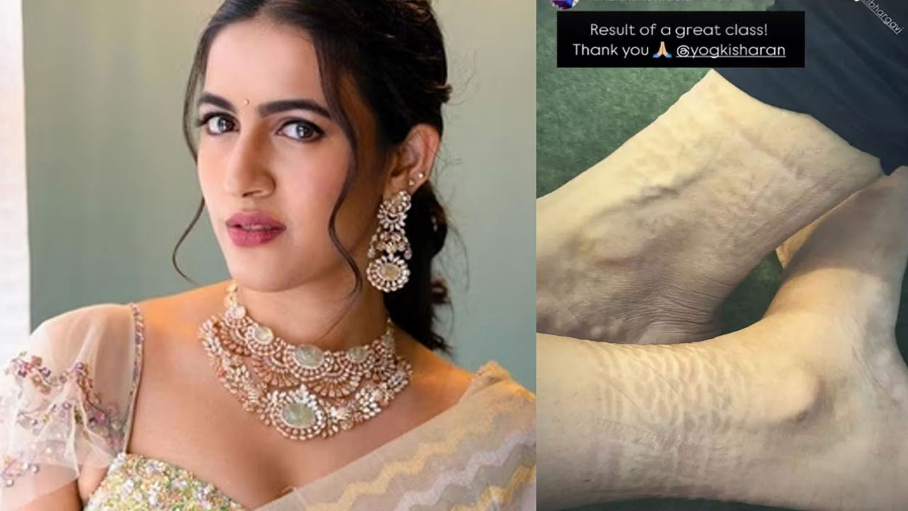Niharika Konidela's Bruised Feet from Dance Practice Worry Fans